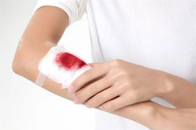 爱尔兰皇家外科医学院研究表明，3D打印的血浆有助于伤口更快愈合