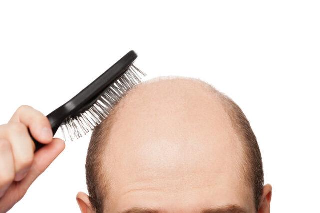 爱尔兰数千脱发患者的福音，政府补贴500欧元给你买假发