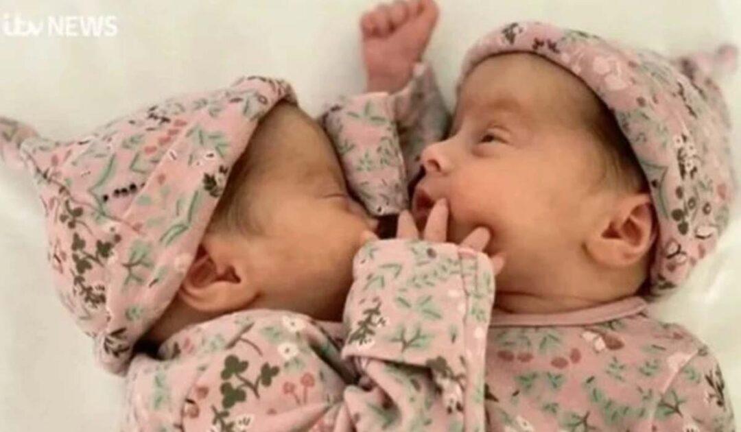 爱尔兰父母在节目中公开谈论“奇迹”连体双胞胎的情况