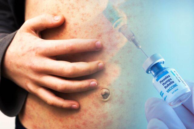 爱尔兰麻疹危机再升级！第5例确诊，HSE呼吁接种疫苗
