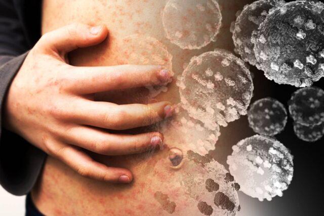 紧急公共卫生警告，都柏林15区儿童游乐中心确诊麻疹病例
