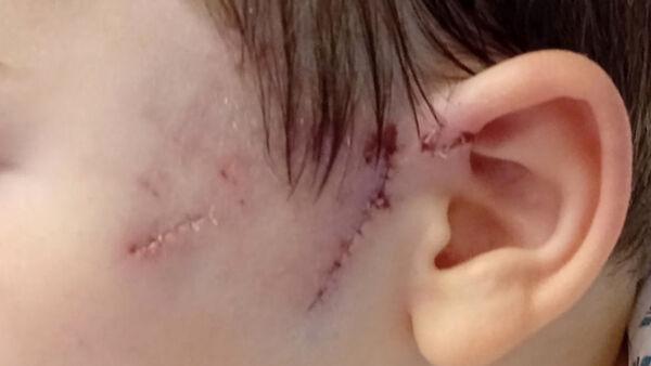 利默里克8岁男孩公园摸狗被咬，面部被撕裂缝了30针